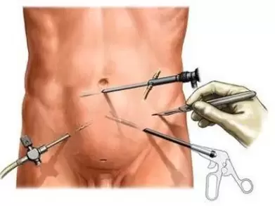 prostatitis kronikoaren tratamendu kirurgikoa