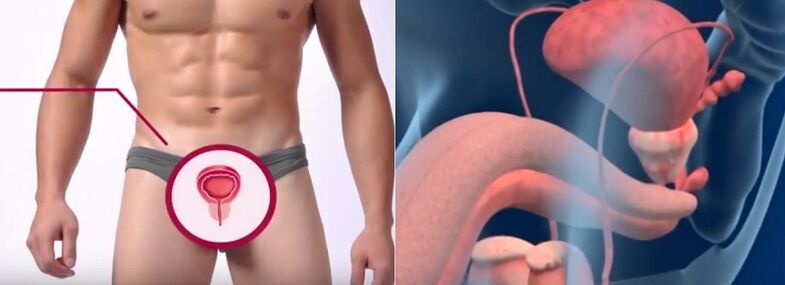 Gizonezkoetan prostatitisa, zeinu jakin batzuen bidez ezagutzen dena