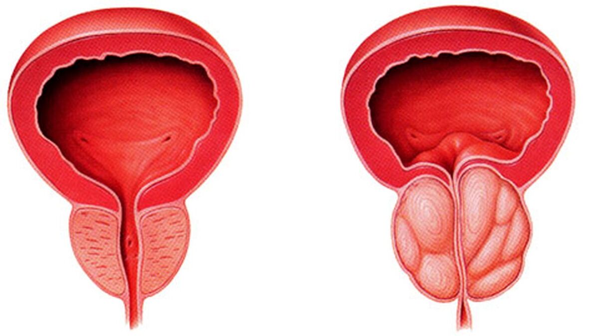 prostatitisarekin prostata osasuntsu eta hanturatuta